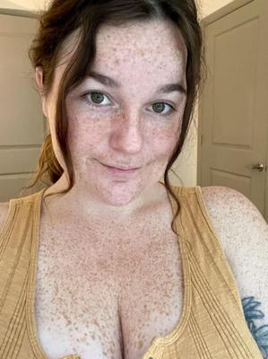 Freckletastic