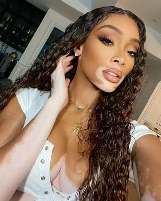 Winnie Harlow (Chantelle Brown joven)